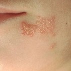 Diagnostico Diferencial en Infecciones de piel y Herpes