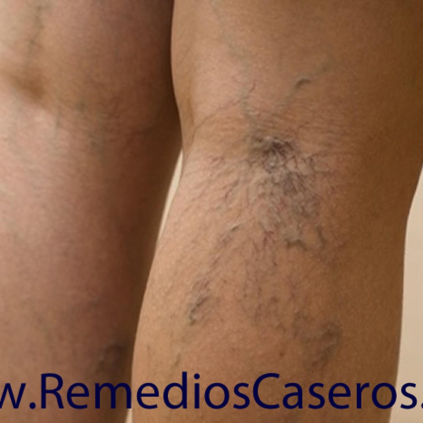 Remedios Caseros