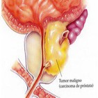 Cáncer de Próstata, con Nino Canún.