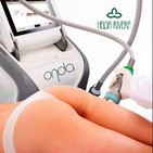 Ondas micro: una solucion segura contra la celulitis, la grasa y la flacidez