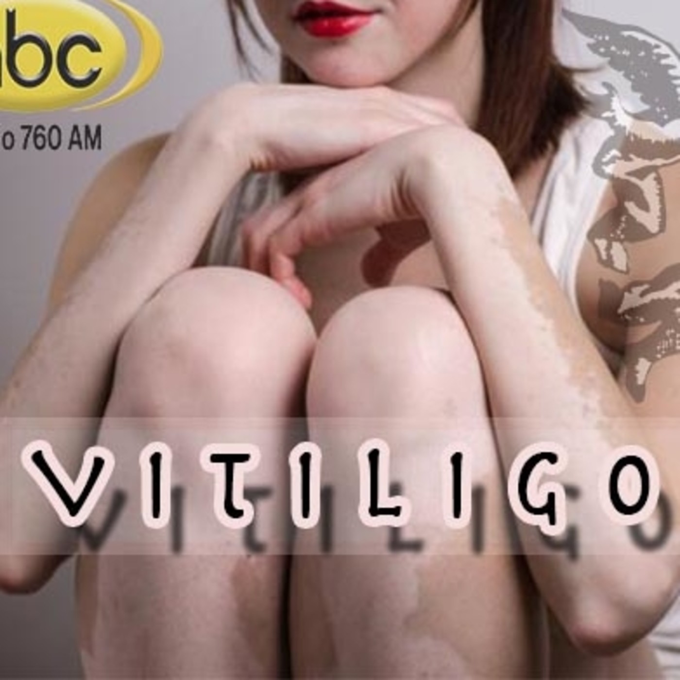 El Angel de tu Salud - VITILIGO II episode artwork