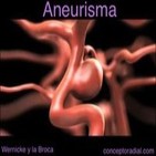 Aneurisma