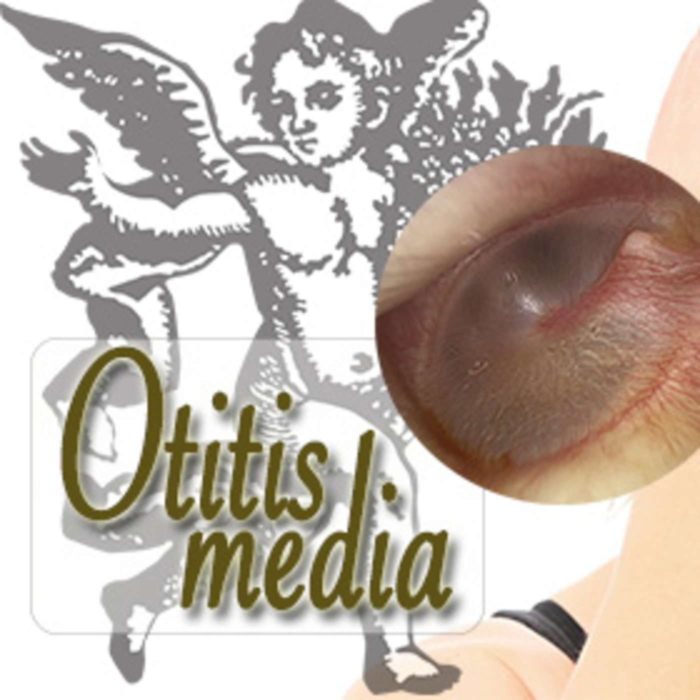 El Angel de tu Salud - OTITIS MEDIA
