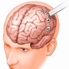 Novedoso proceder: Mapeo cerebral del lenguaje en paciente despierto