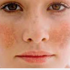 ELIMINAR LAS ROJECES DEL ROSTRO, con Helga Rivera
