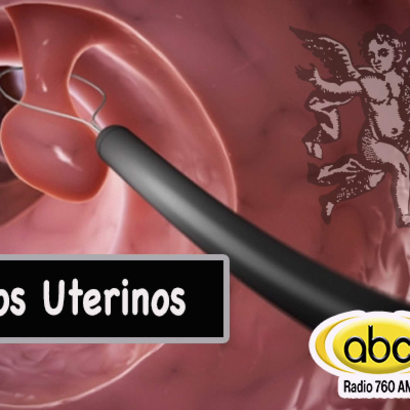 El Ángel de tu Salud - PÓLIPOS UTERINOS episode artwork