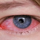 Sequedad, irritación de ojos con homeopatía y biorresonancia