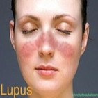 Lupus