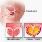 Tratamiento médico HBP