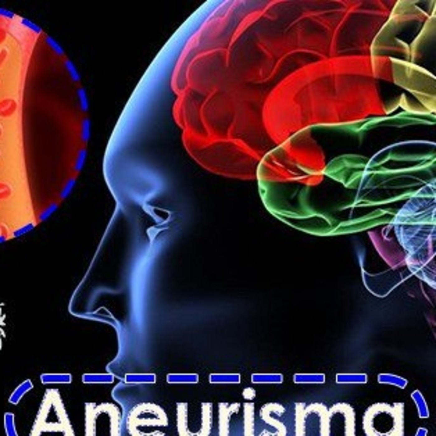 El Angel de tu Salud - ANEURISMA