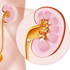 Litiasis urinarias by Gerard Capellas
