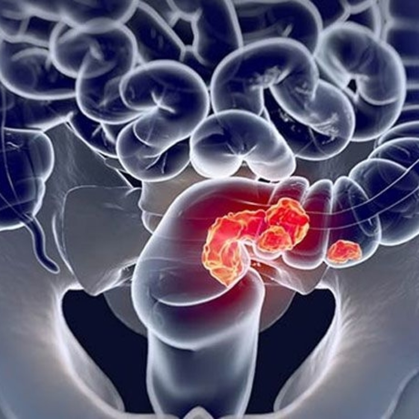 Células troncales y cáncer