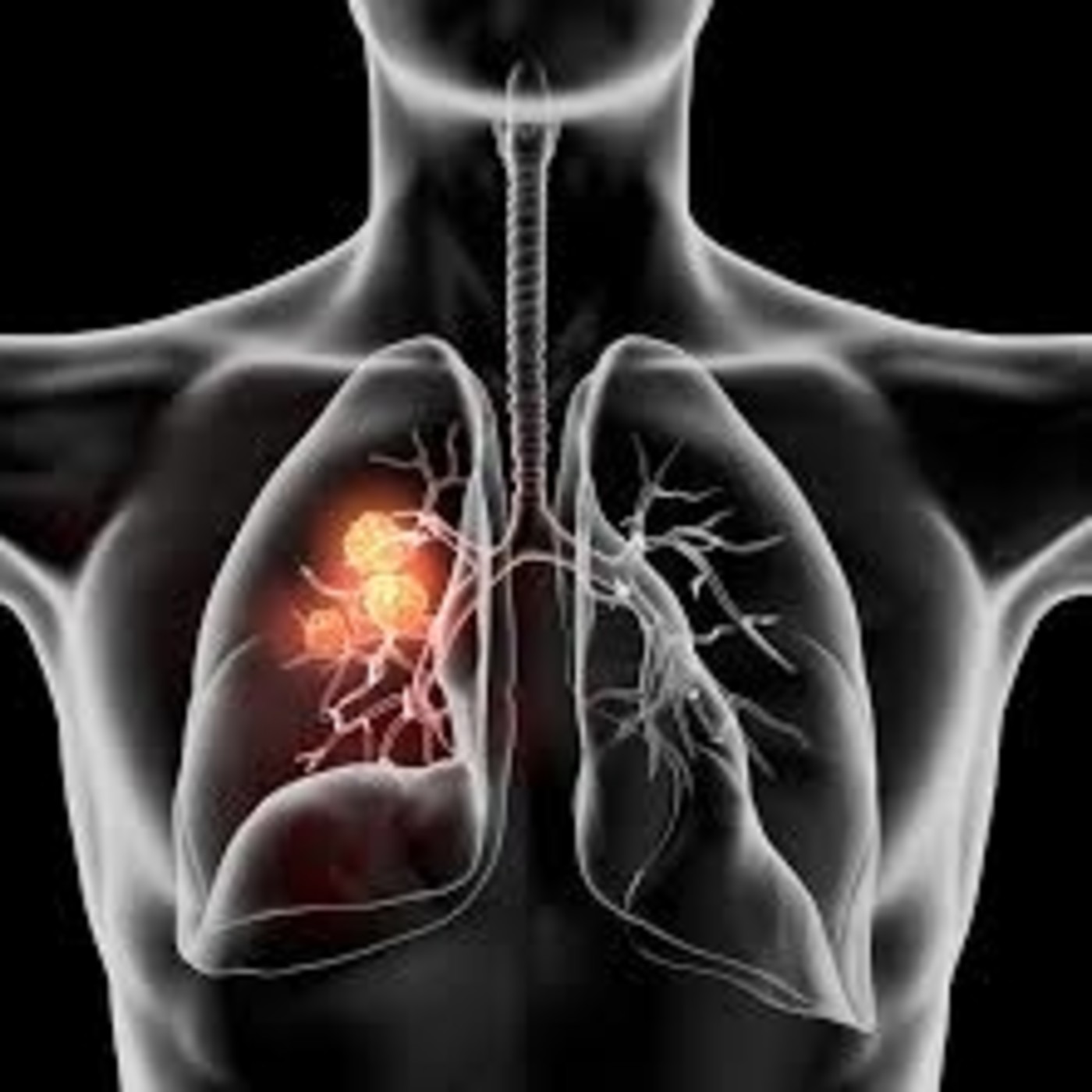 Células troncales y cáncer