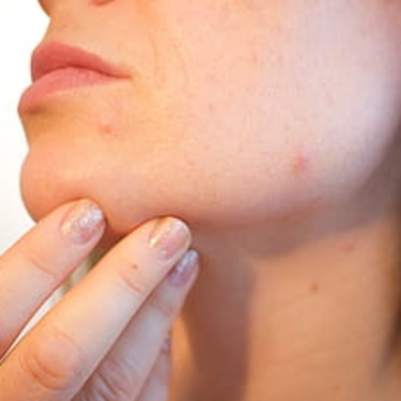 Respondiendo preguntas sobre acné