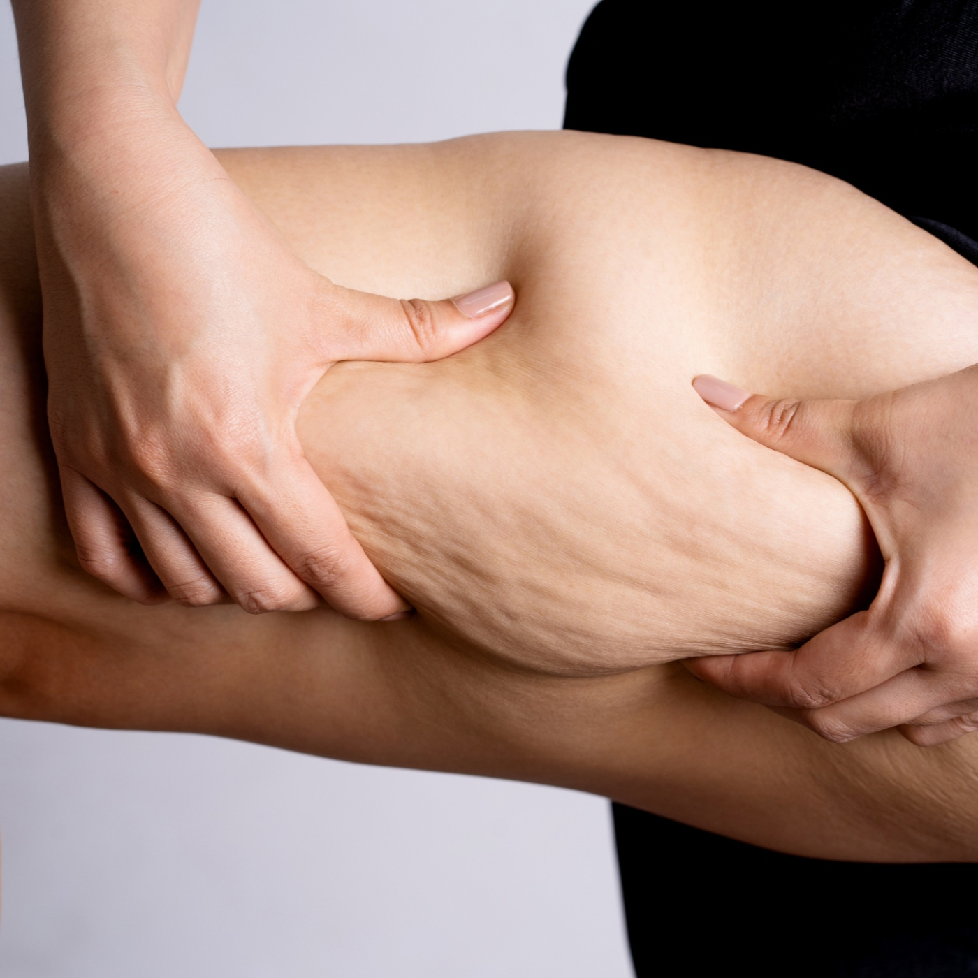 ACUMULACIÓN DE GRASA EN PIERNAS, con Dra. Helga Rivera