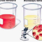 Hematuria.