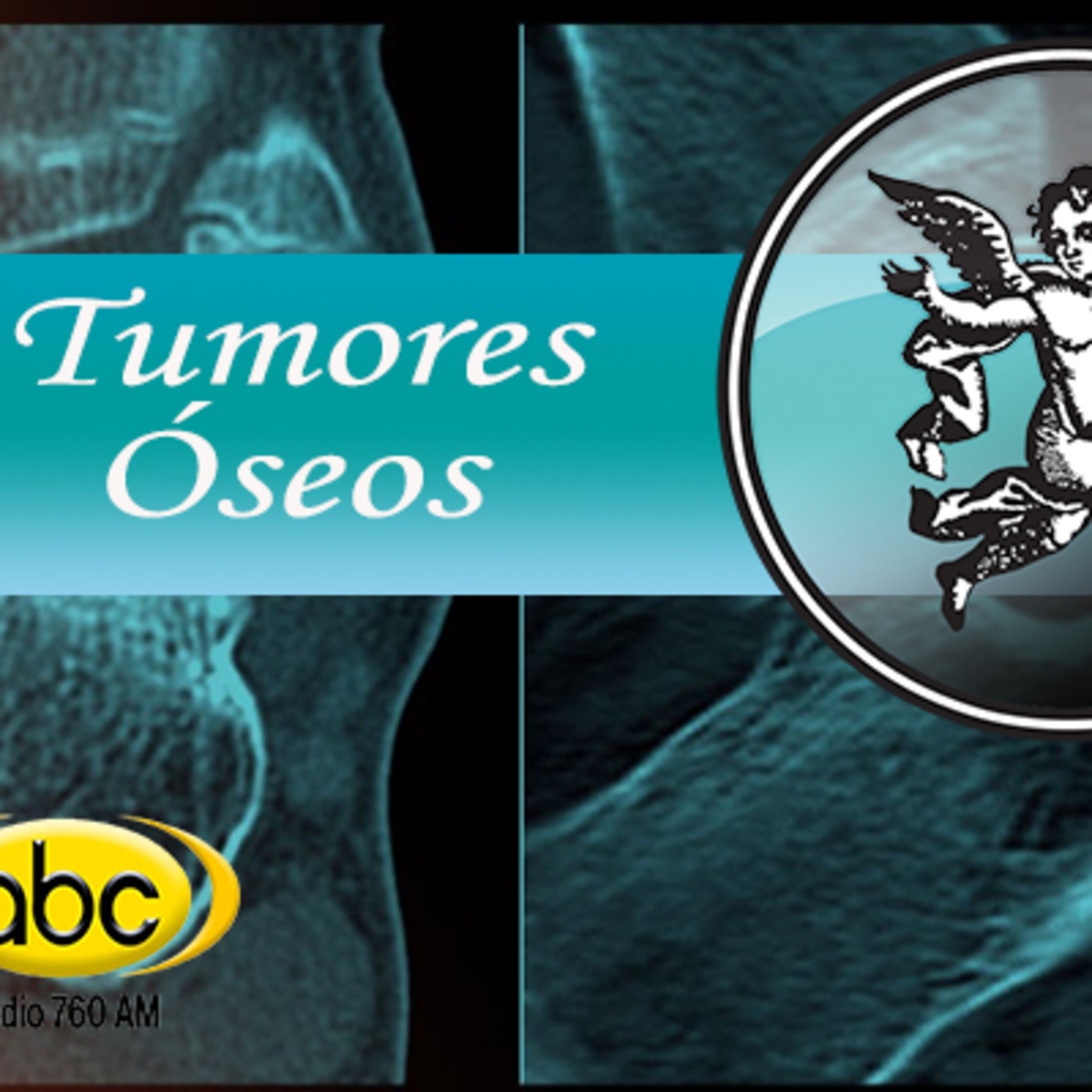 El Angel de tu Salud - TUMORES ÓSEOS