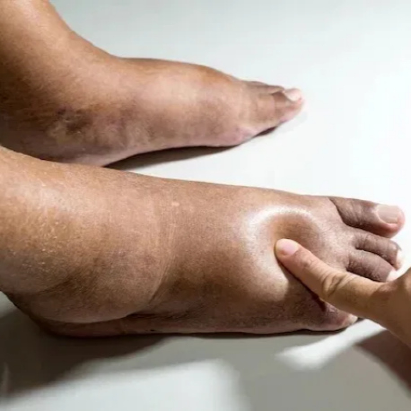 Medicina natural: Una aliada contra los trastornos circulatorios tras el chikungunya